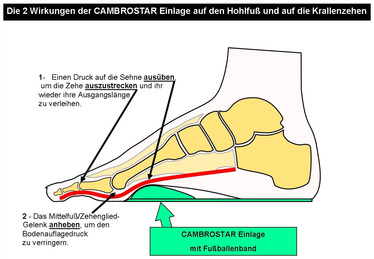 Skelettschema Hohlfüße mit CAMBROSTAR Einlage